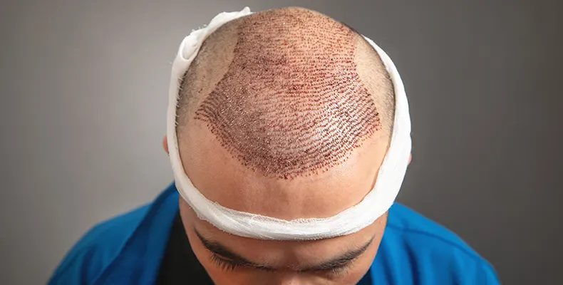 Guide to Hair Transplant