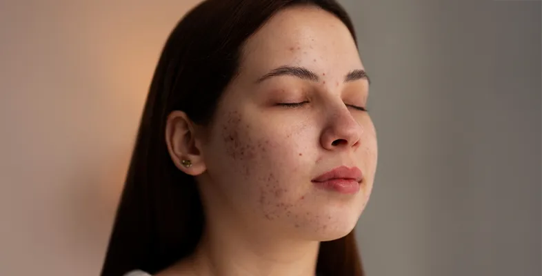 Acne Scars Service Banner