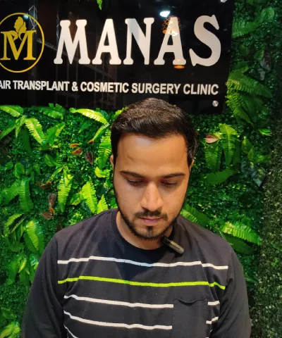After Hair Transplant 2