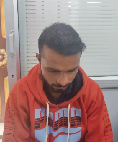 After Hair Transplant 4