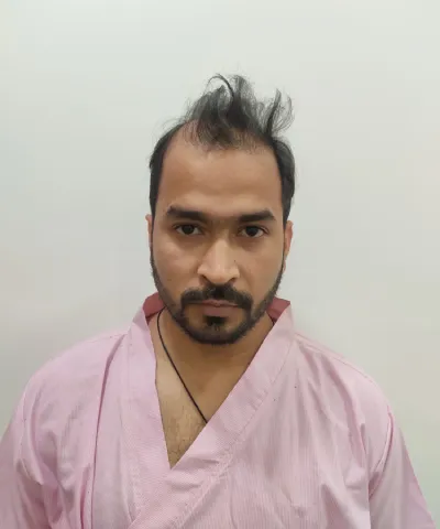 Before Hair Transplant 1