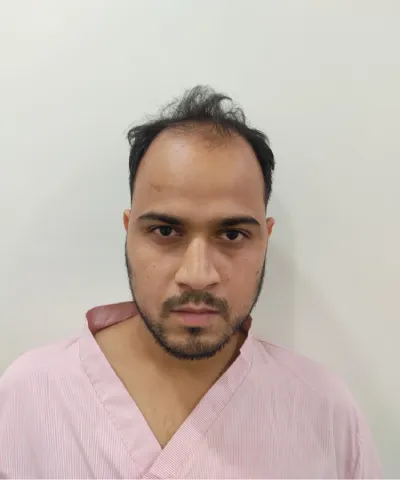 Before Hair Transplant 2