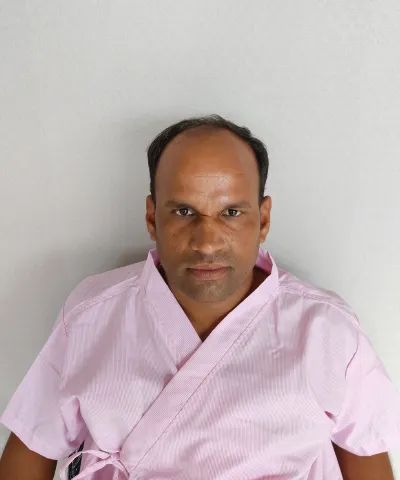 Before Hair Transplant 3