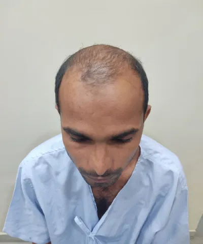 Before Hair Transplant 4