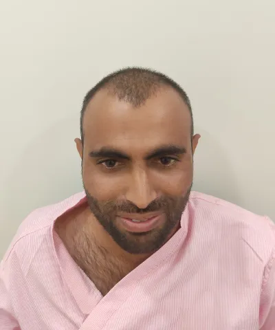 Before Hair Transplant 5