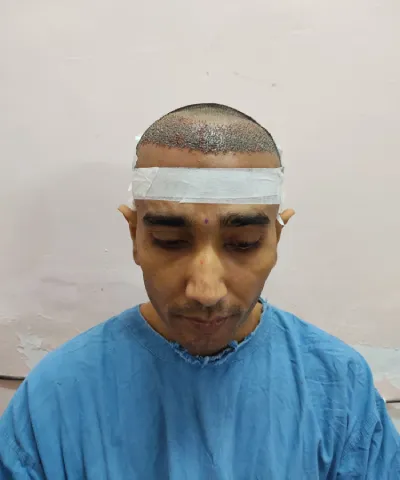 Before Hair Transplant 6
