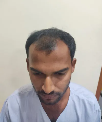 Before Hair Transplant 7