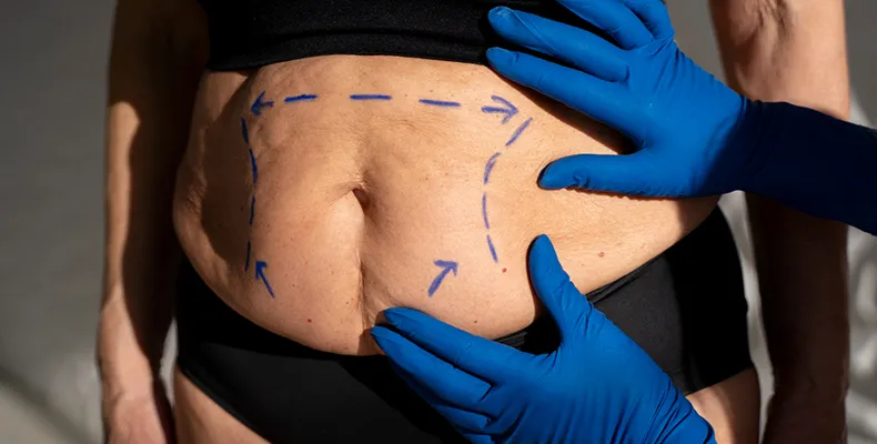 Liposuction Service Banner